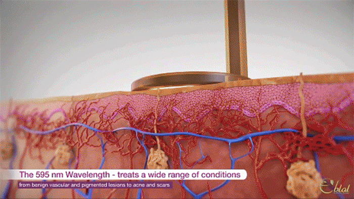 染料雷射_悠美診所 染料雷射_悠美診所