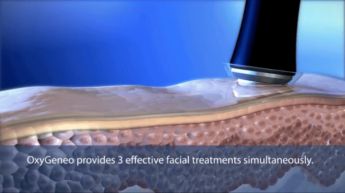活氧泡泡電波OxyGeneo_悠美診所 活氧泡泡電波OxyGeneo_悠美診所