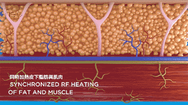 悠美診所_真空.除毛雷射 永久除毛 雷射除毛 EMSCULPTNEO熱磁減脂_悠美診所