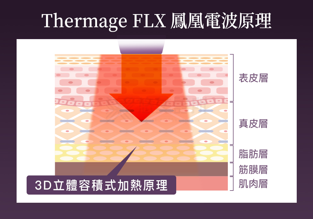 Thermage FLX鳳凰電波 Thermage FLX鳳凰電波