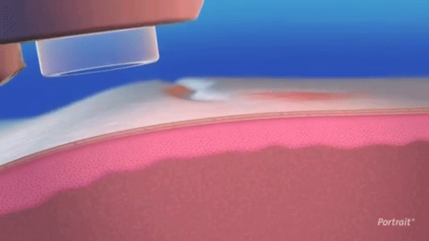 電漿活膚術_悠美診所 電漿活膚術_悠美診所