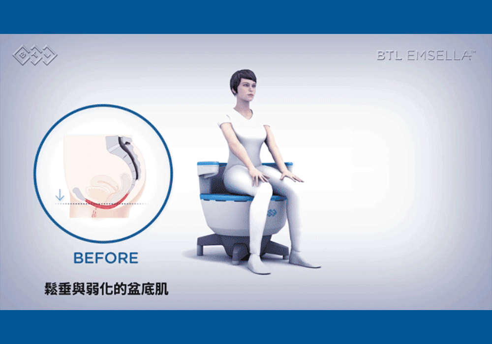 EMSELLA治療椅_悠美診所 EMSELLA治療椅_悠美診所