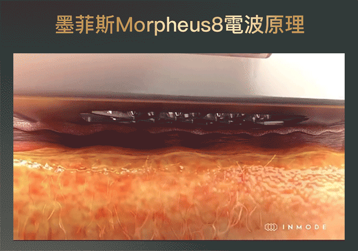 Morpheus8墨菲斯電波 Morpheus8墨菲斯電波