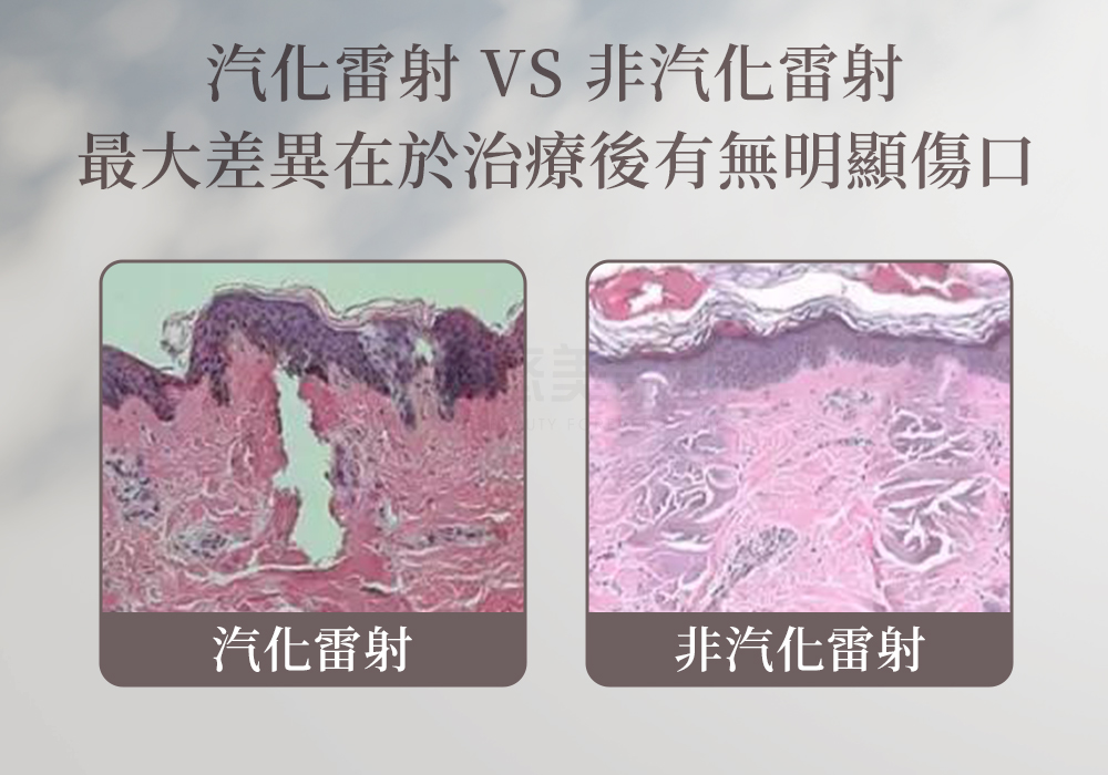 Youlaser雙波飛梭雷射_悠美診所 Youlaser雙波飛梭雷射_悠美診所