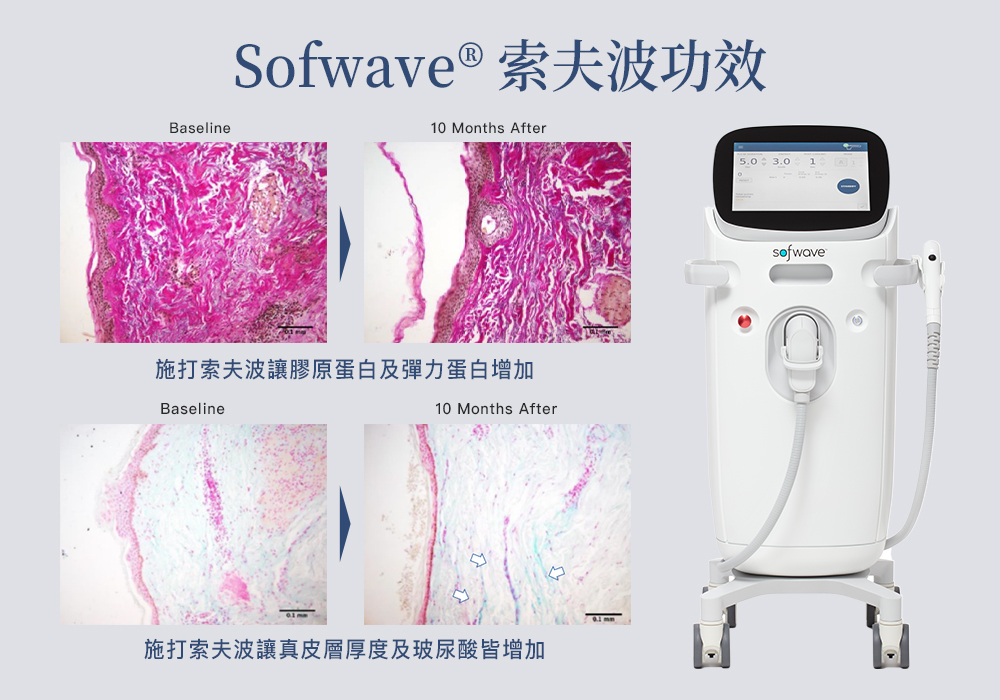 Sofwave®索夫波 Sofwave®索夫波