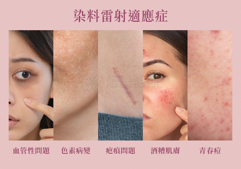 染料雷射_悠美診所 染料雷射_悠美診所