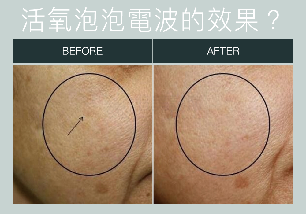 活氧泡泡電波OxyGeneo_悠美診所 活氧泡泡電波OxyGeneo_悠美診所