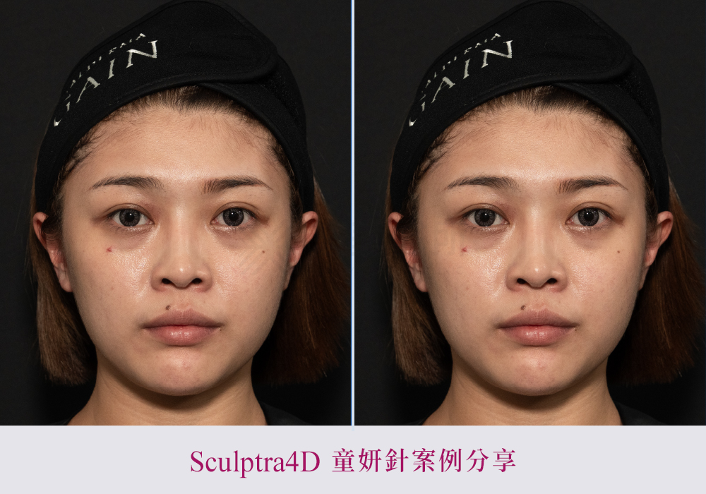 舒顏萃硬塊-悠美診所