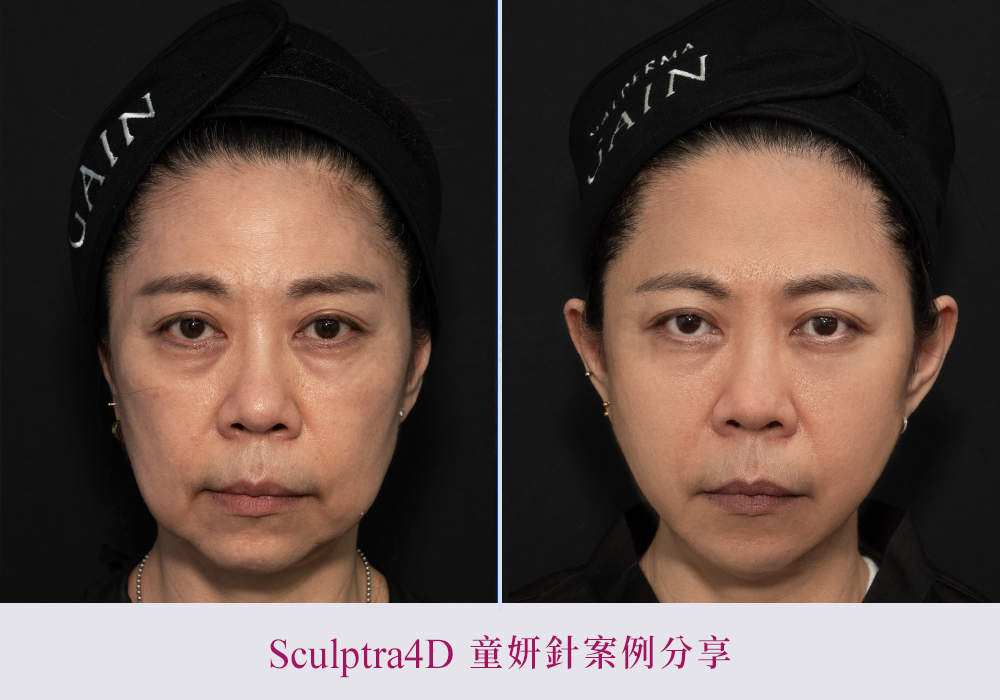 舒顏萃硬塊-悠美診所