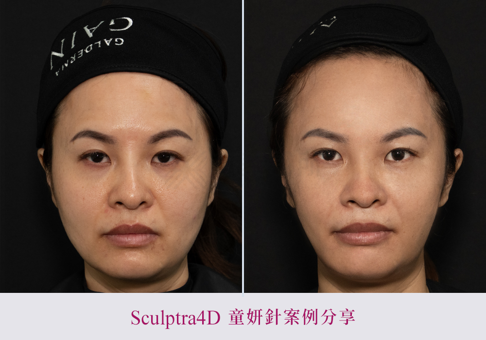 舒顏萃硬塊-悠美診所