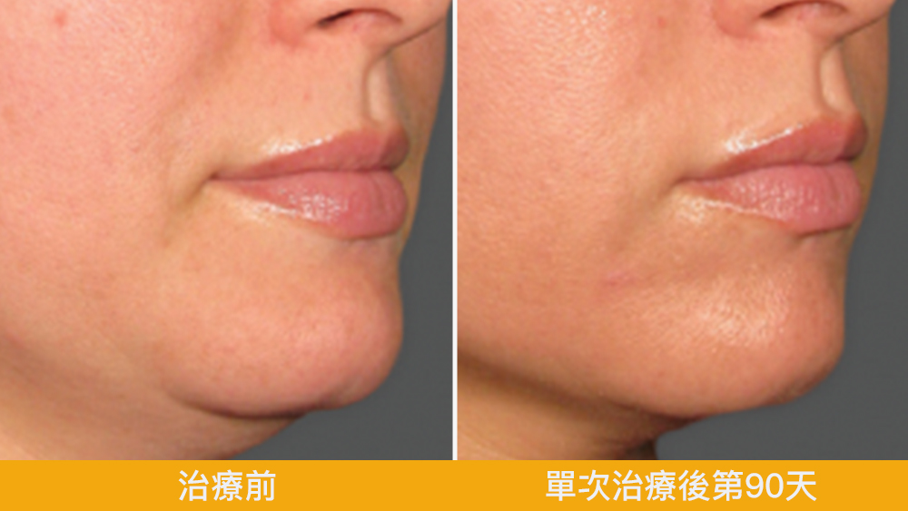 美國音波Ulthera Prime悠美診所