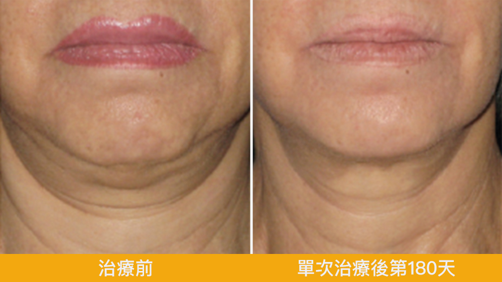 美國音波Ulthera Prime悠美診所