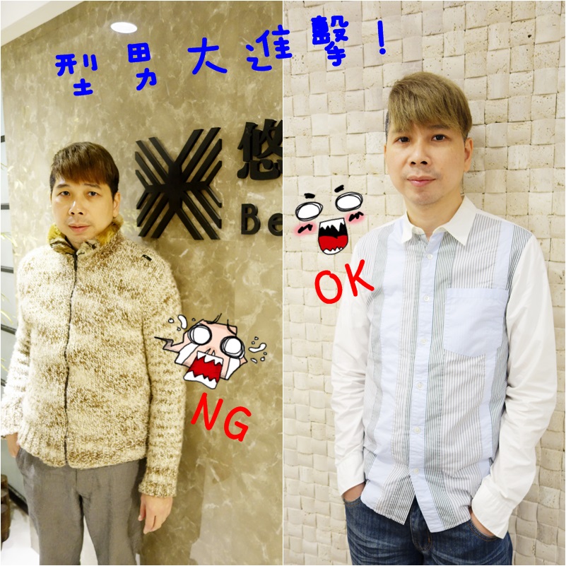 外開眼袋 割雙眼皮 悠美診所