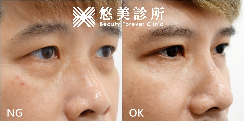 外開眼袋 割雙眼皮 悠美診所