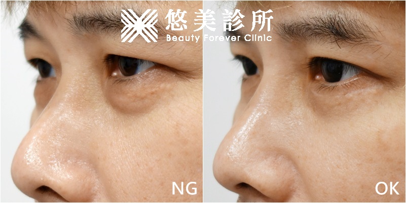 外開眼袋 割雙眼皮 悠美診所