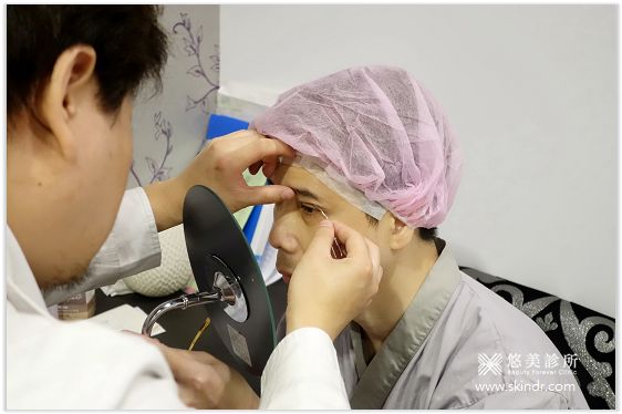 外開眼袋 割雙眼皮 悠美診所