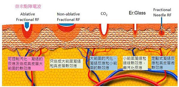 電波拉皮+眼周肉毒 悠美診所