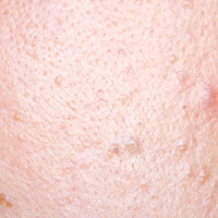 白頭粉刺_悠美中醫