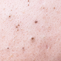 黑頭粉刺_悠美中醫