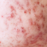 囊腫型青春痘_悠美中醫