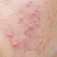 紅腫型青春痘_悠美中醫