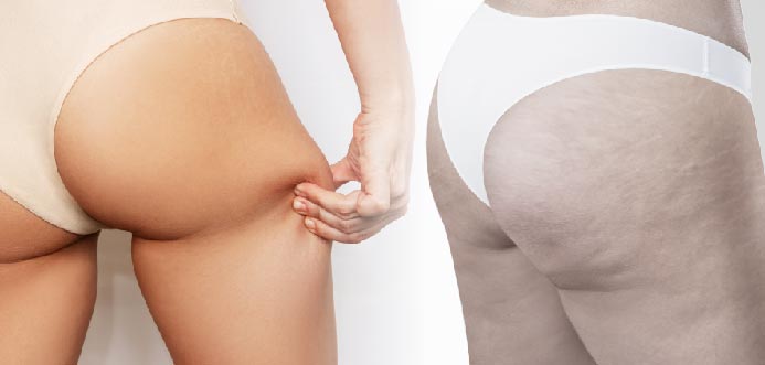 橘皮撫平-悠美診所