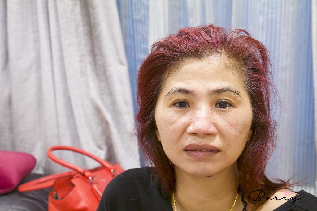 皮秒雷射 紅寶石雷射 悠美診所