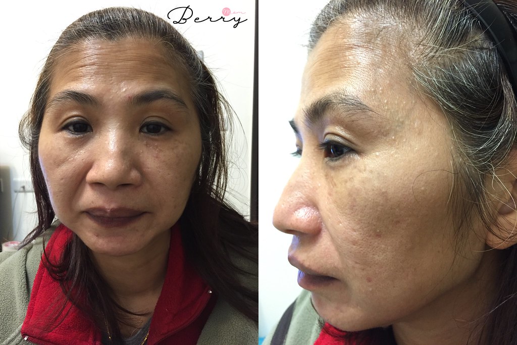 皮秒雷射 紅寶石雷射 悠美診所