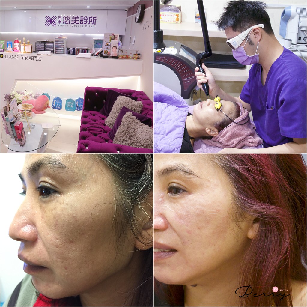 皮秒雷射 紅寶石雷射 悠美診所