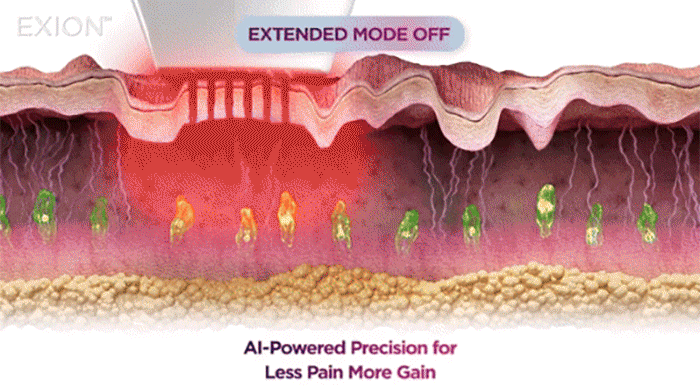 EMTONE擊脂槍_悠美診所 EXION艾可塑電波_悠美診所