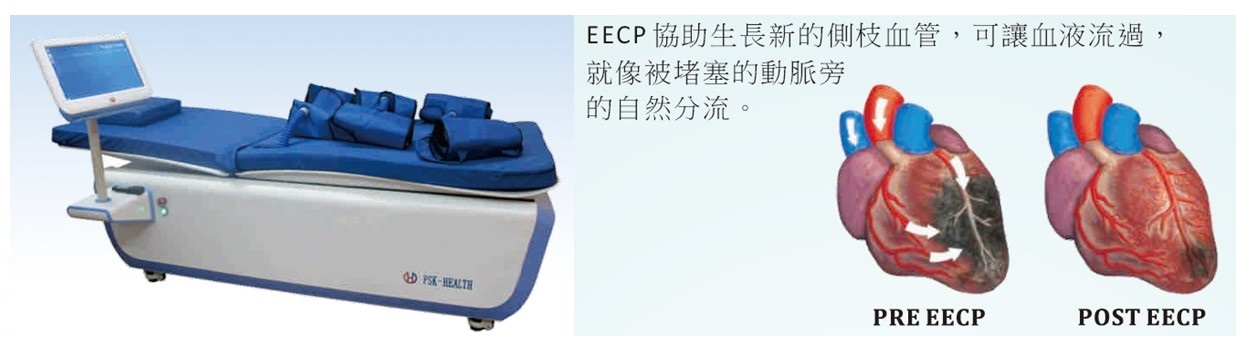 EECP體外反搏-悠美診所