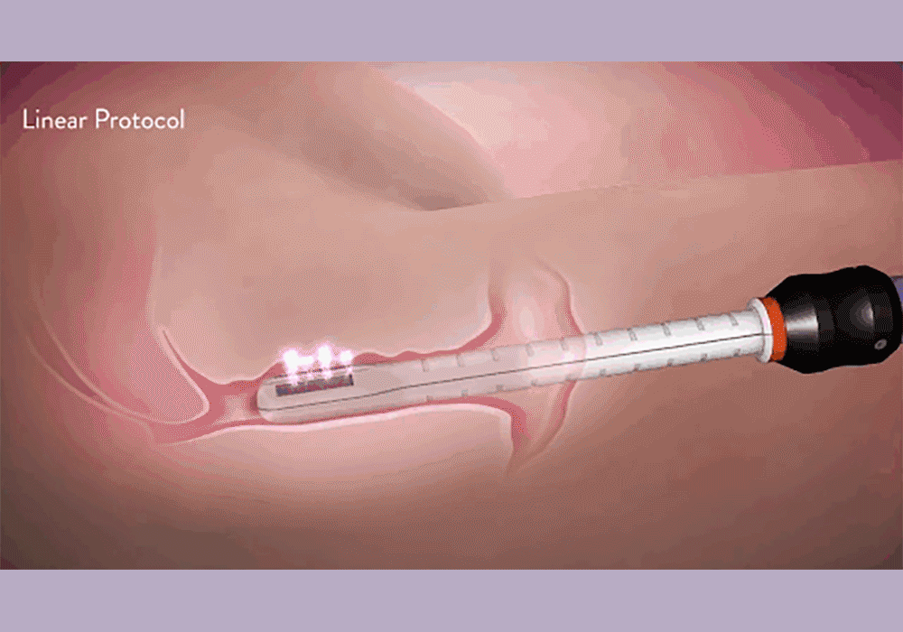 悠美診所蝴蝶電波vs薇薇電波怎麼選?